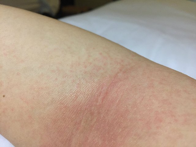在皮肤起疹子的期间人们可以洗澡吗
