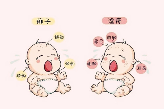 湿疹和荨麻疹具体存在着哪些区别