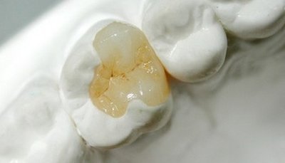补完牙齿之后过多久可以开始吃东西