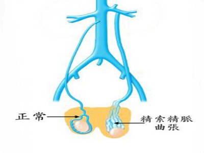 浅静脉扩张的临床表现和诊断方法
