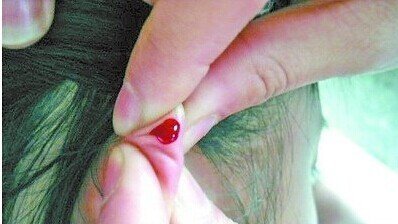 放血疗法的效果放血疗法可以治疗哪些疾病