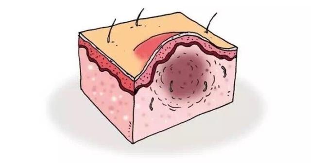 毛囊炎反复发作的原因以及治疗方法
