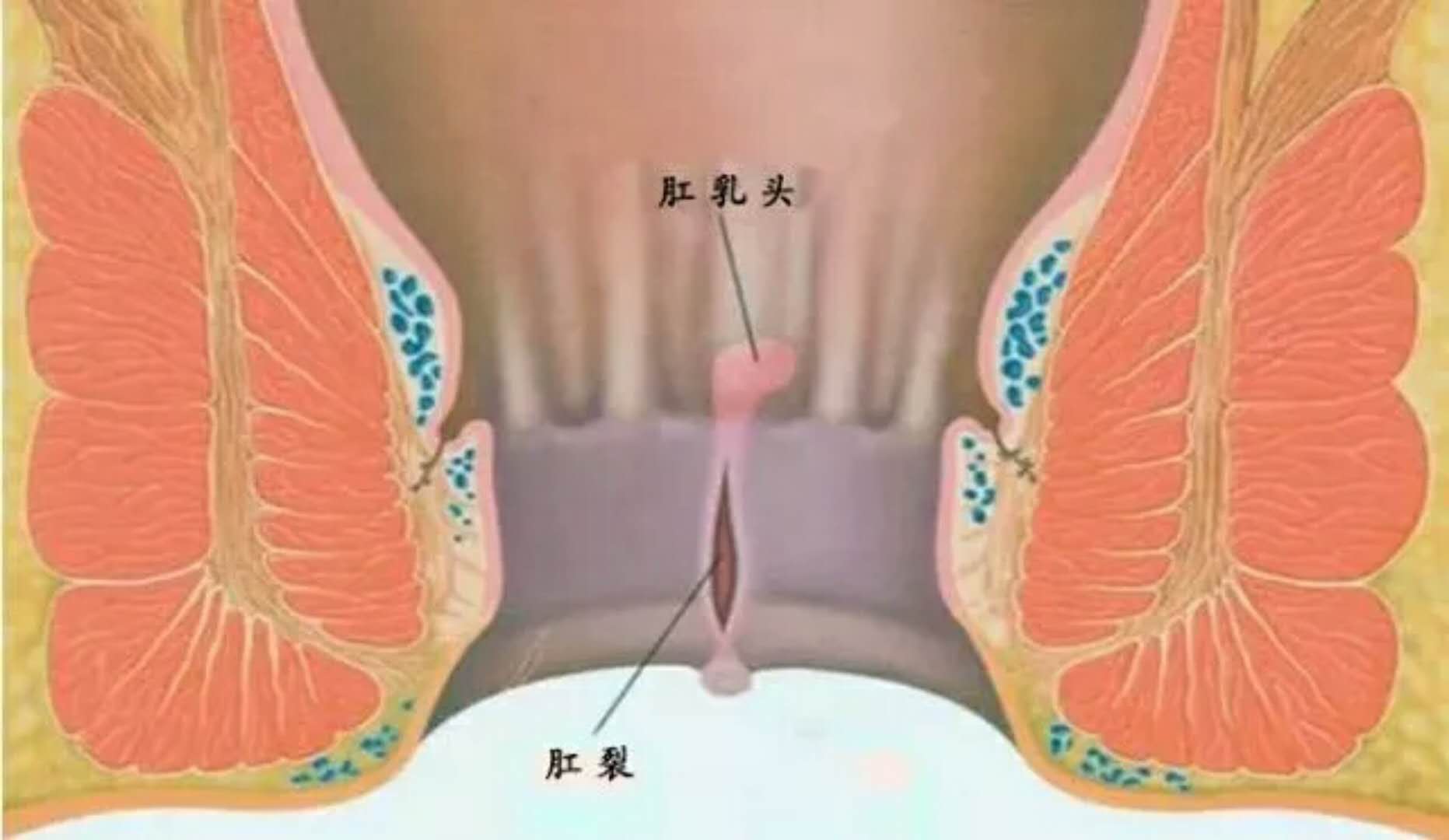 四种肛肠疾病即将出现的早期症状