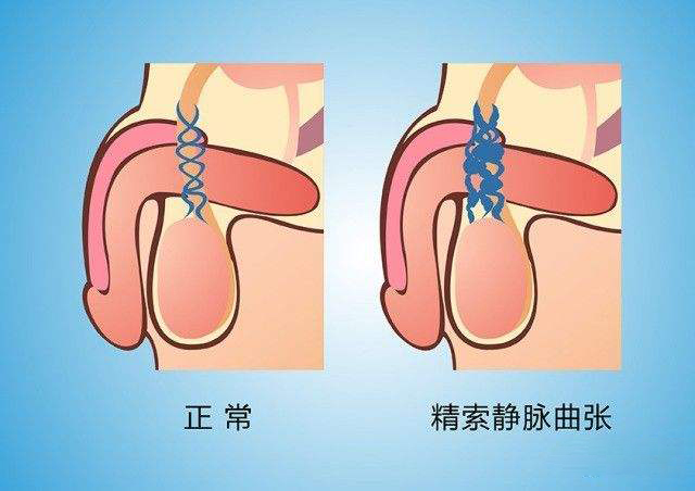 静脉曲张患者的腿部水肿治疗方法