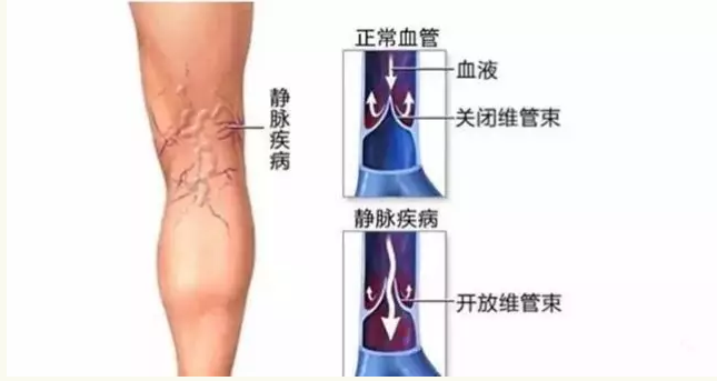 喝酒是否会影响到静脉曲张患者的健康