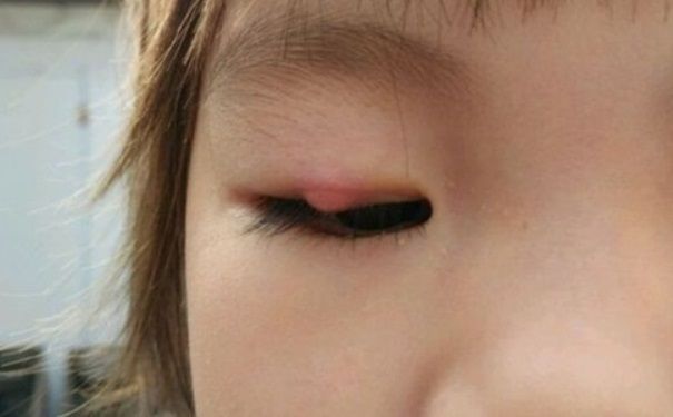 长针眼的处理方法和针眼的治疗方法