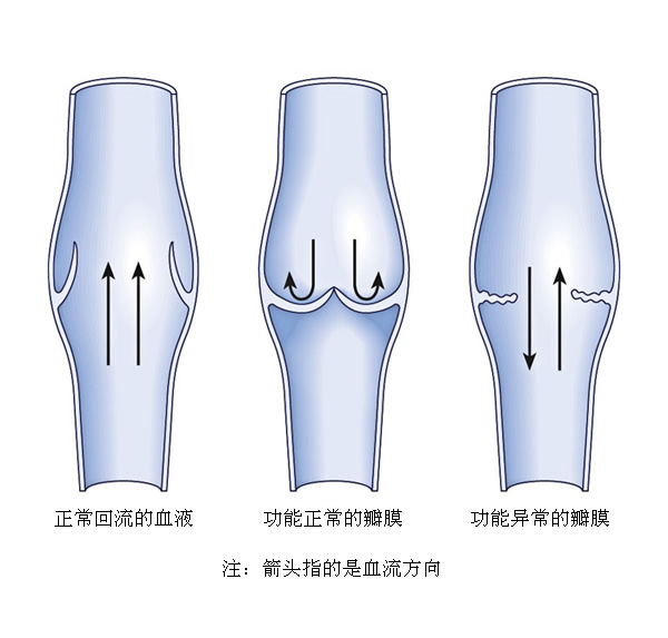 小腿静脉曲张的治疗方法如何治根