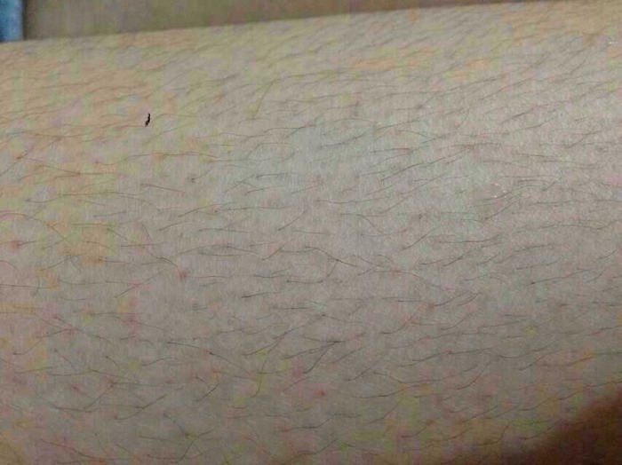 去腿毛的效果能够达到永久去除吗